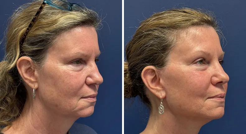 Before and after facelift: patient's face from the right side