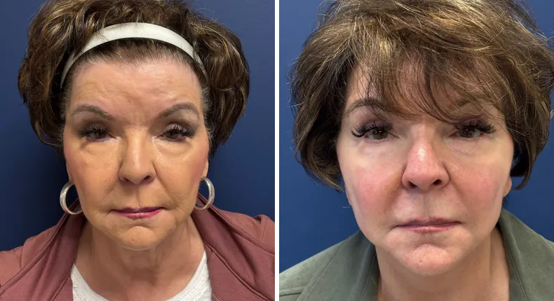 Before and after facelift: patient's face