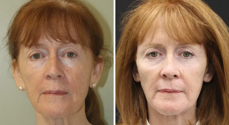 Before and after facelift: patient's face from the front, with neck lift