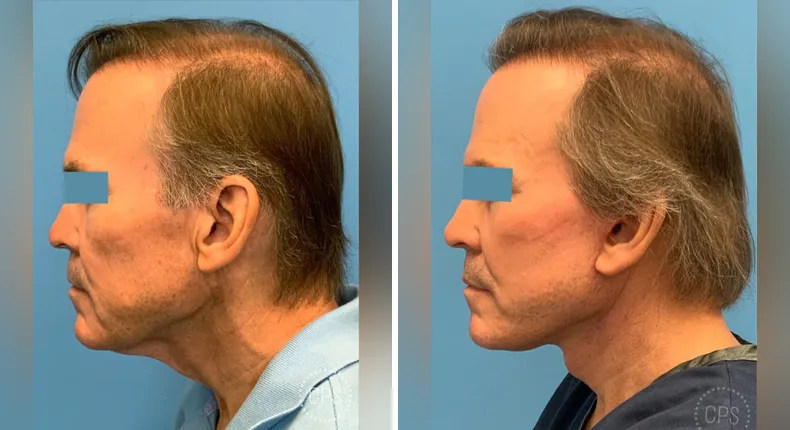 Before and after facelift: man's face