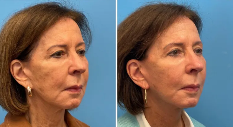 Before and after facelift: woman's face at a right angle