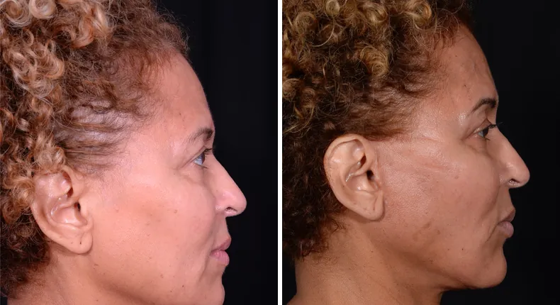 Before and after facelift: patient's face from the right side
