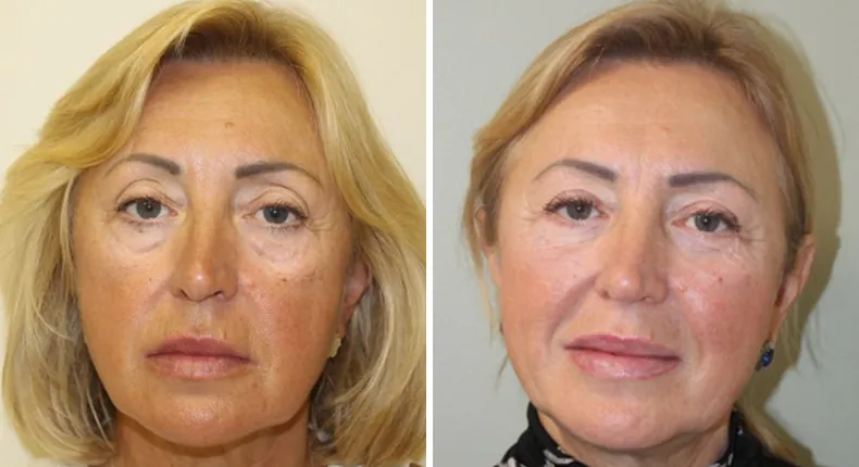 Before and after facelift: patient's face