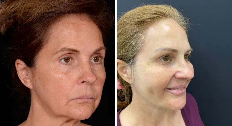 Before and after facelift: patient's face at a right angle, with neck lift and Face360