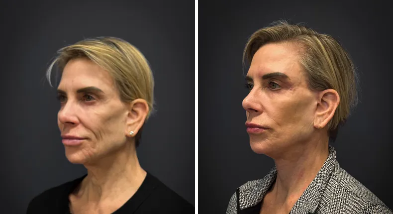 Before and after facelift: patient's face from the left side