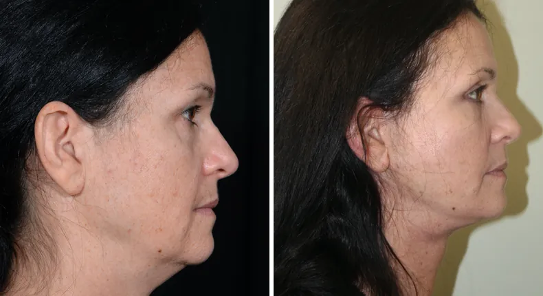 Before and after facelift: patient's face in right profile, with neck lift