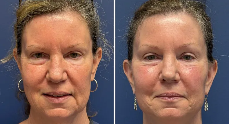 Before and after facelift: patient's face
