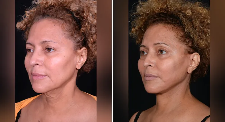 Before and after facelift: patient's face at a left angle, with neck lift