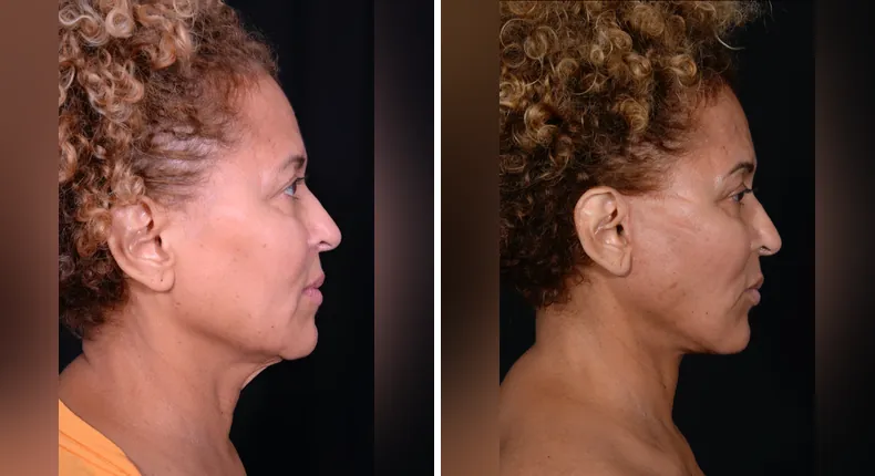 Before and after facelift: patient's face in right profile, with neck lift