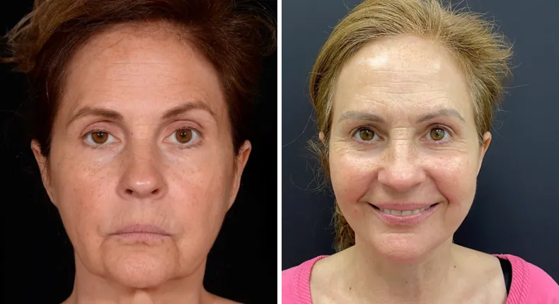 Before and after facelift: patient's face from the front, with neck lift and Face360
