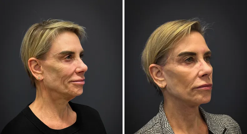 Before and after facelift: patient's face from the right side