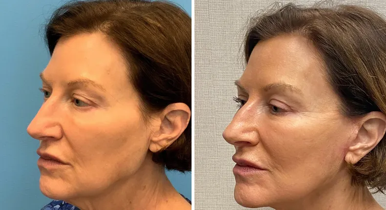 Before and after facelift: woman's face at a left angle