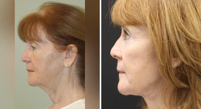 Before and after facelift: patient's face in left profile, with neck lift