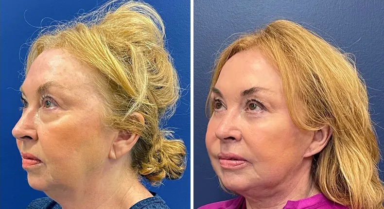Before and after facelift: woman's face from the left side