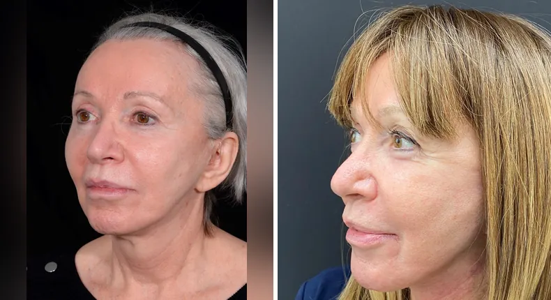 Before and after facelift: patient's face at a left angle