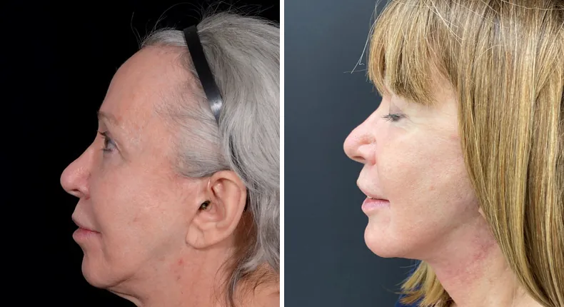 Before and after facelift: patient's face from the left side
