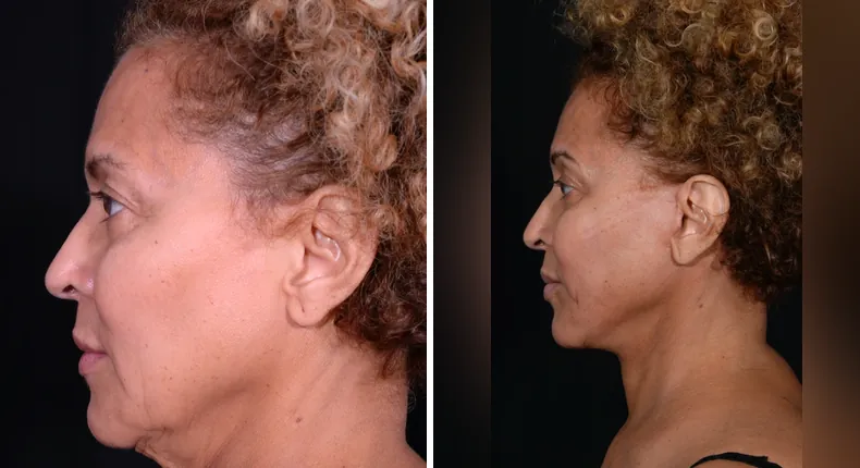 Before and after facelift: patient's face in left profile, with neck lift