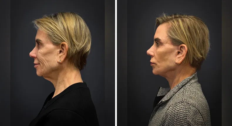 Before and after facelift: patient's face from the left side
