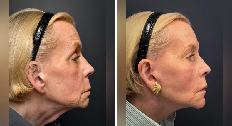 Before and after facelift: patient's face from the right side