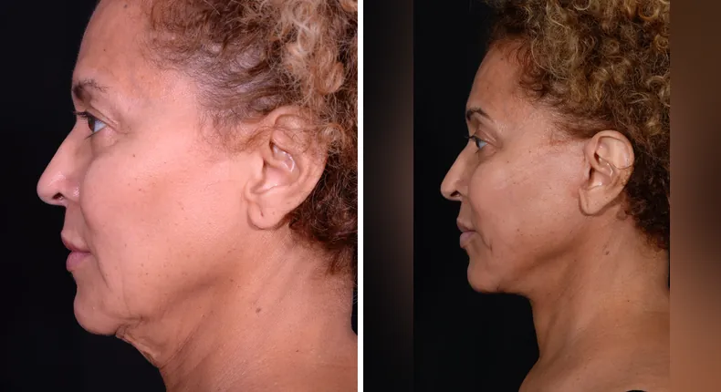 Before and after facelift: patient's face from the left side