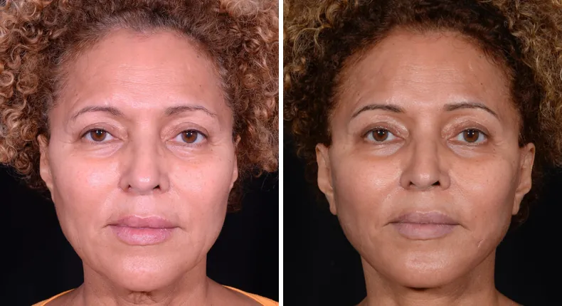 Before and after facelift: patient's face from the front