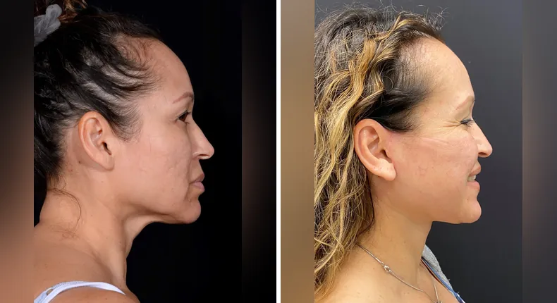 Before and after facelift: patient's face from the right side