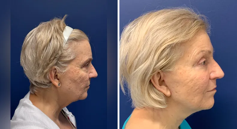 Before and after facelift: patient's face from the right side