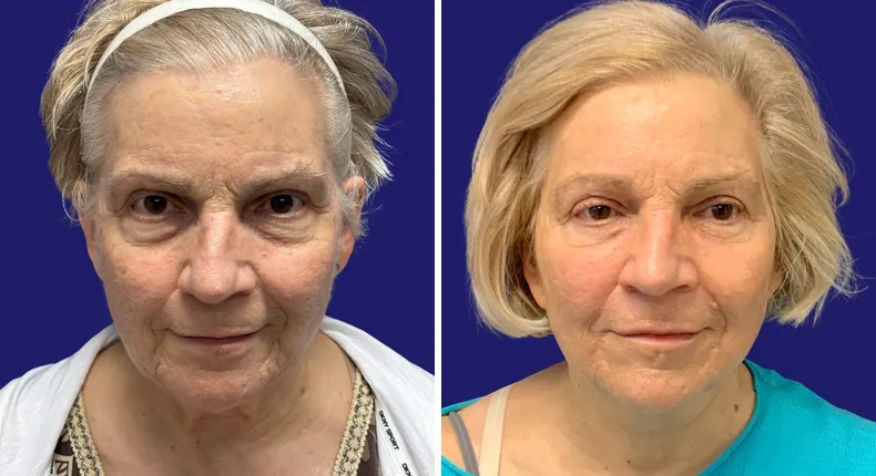 Before and after facelift: woman's face