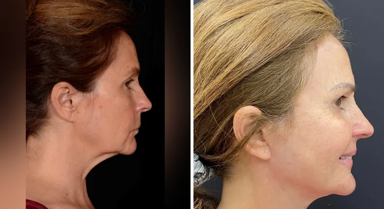 Before and after facelift: patient's face in right profile, with neck lift and Face360