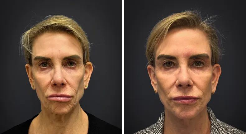 Before and after facelift: patient's face from the front