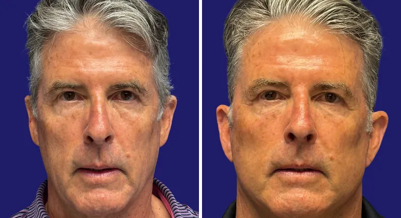Before and after facelift: man's face from the front