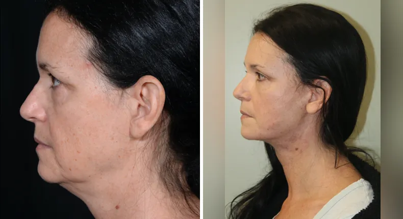 Before and after facelift: patient's face in left profile, with neck lift