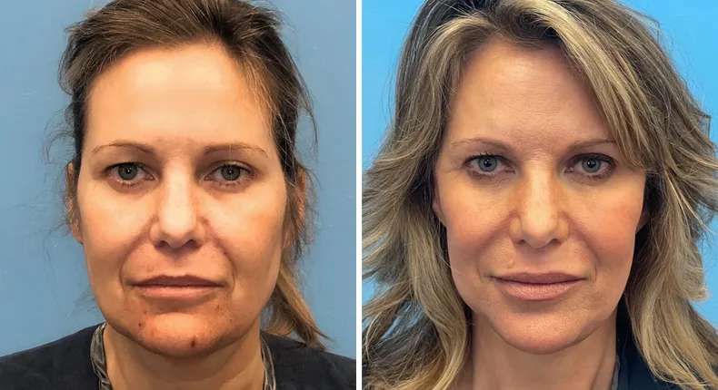 Before and after facelift: patient's face from the front