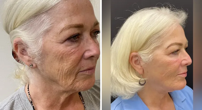 Before and after facelift: patient's face at a right angle, with neck lift