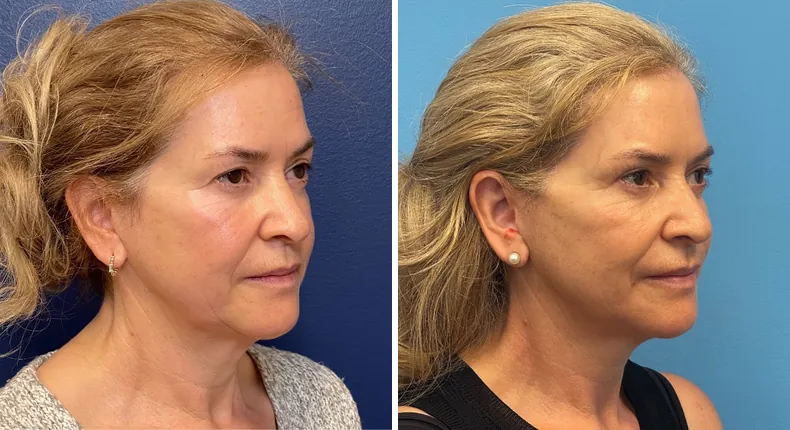 Before and after facelift: patient's face at a right angle