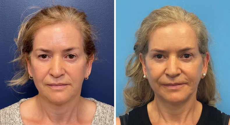 Before and after facelift: patient's face from the front