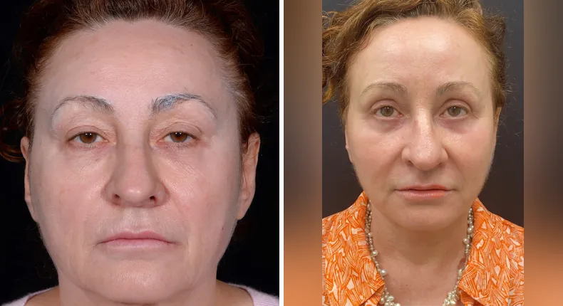 Before and after facelift: patient's face from the front