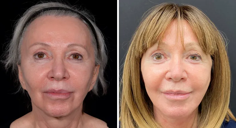 Before and after facelift: patient's face from the front