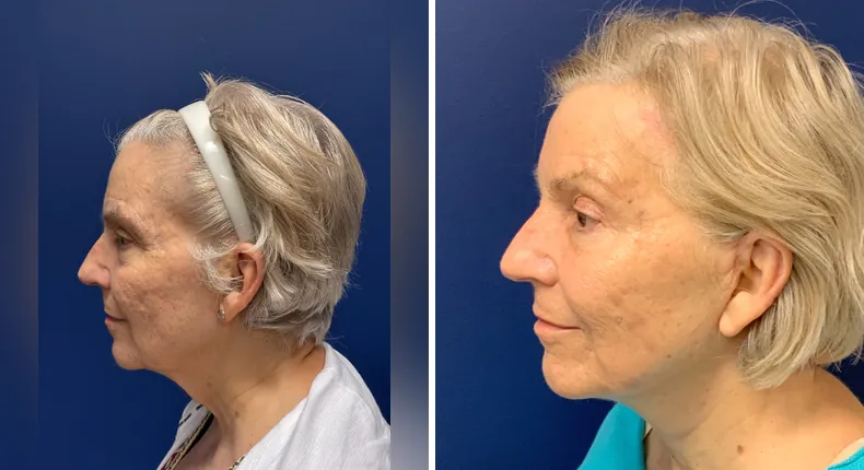 Before and after facelift: patient's face from the left side