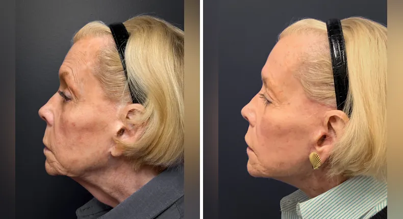Before and after facelift: patient's face from the left side