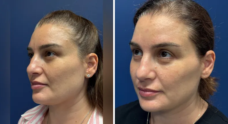 Before and after facelift: patient's face from the left side, with facial fat grafting