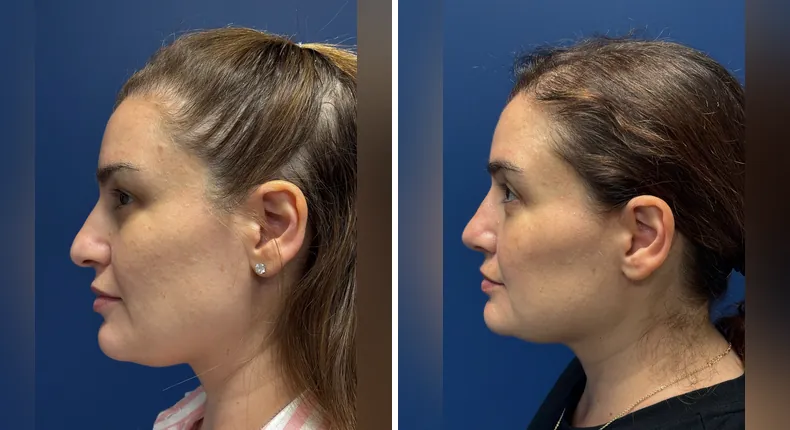 Before and after facelift: patient's face from the left side, with facial fat grafting