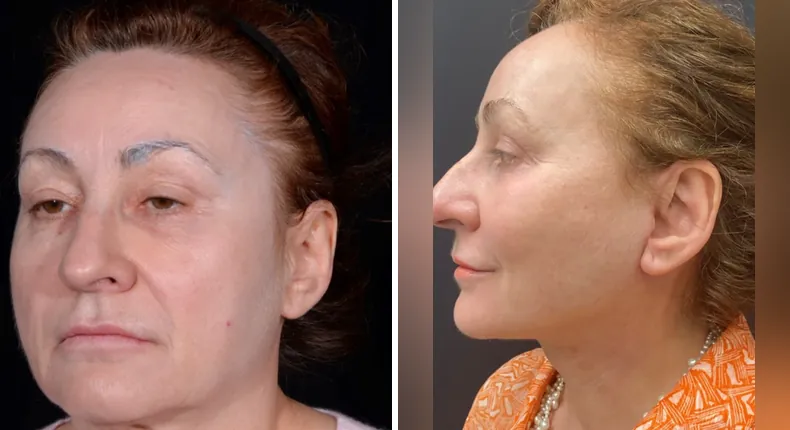 Before and after facelift: patient's face at a left angle, with neck lift