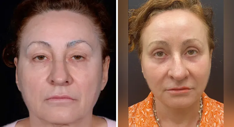 Before and after facelift: patient's face from the front, with neck lift