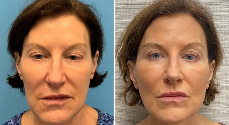 Before and after facelift: woman's face from the front