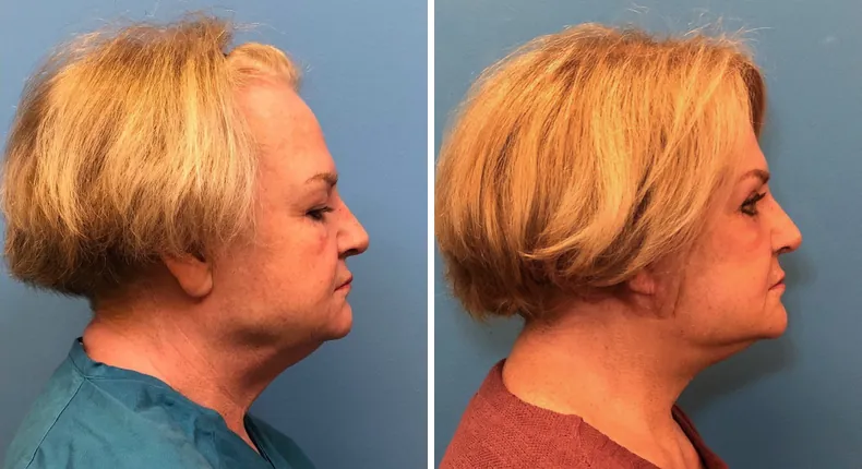 Before and after facelift: patient's face from the right side