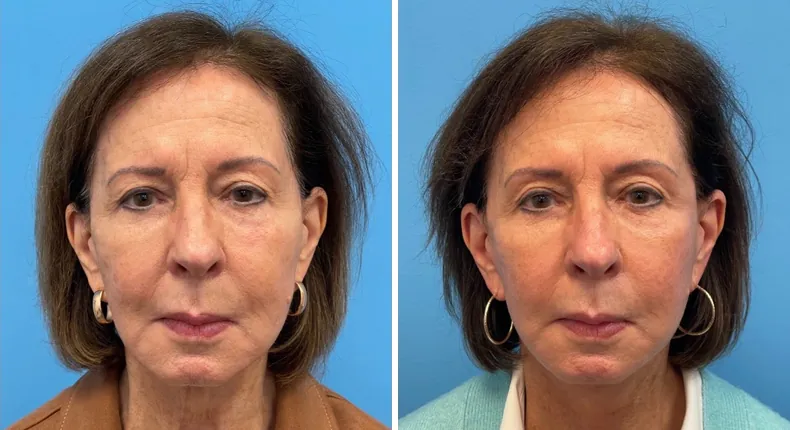 Before and after facelift: woman's face from the front