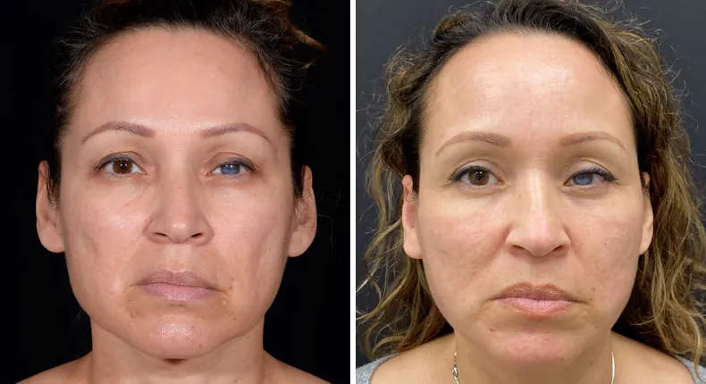 Before and after facelift: patient's face from the front