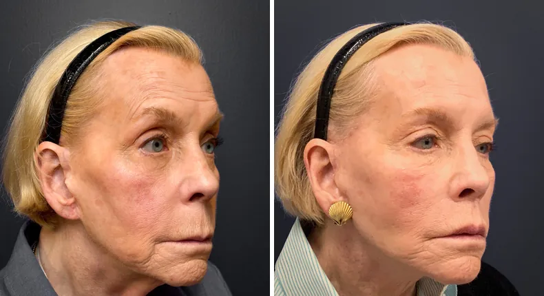 Before and after facelift: patient's face at a right angle
