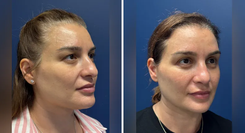 Before and after facelift: patient's face from the right side, with facial fat grafting